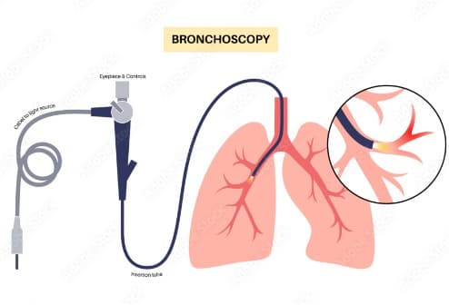 Bronchoscopy